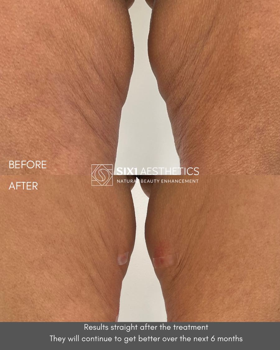 Endolaser before and after photos of inner thighs showing firmer, smoother skin immediately after one treatment at SIX1 Aesthetics in Bracknell, Berkshire