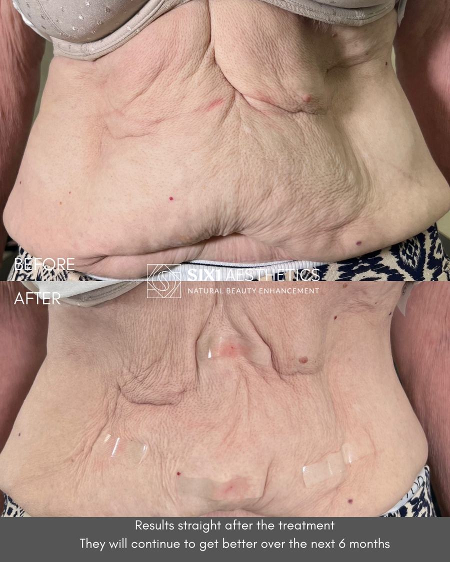 Endolaser before and after photos of a woman’s stomach showing tighter, smoother skin immediately after one treatment at SIX1 Aesthetics in Bracknell