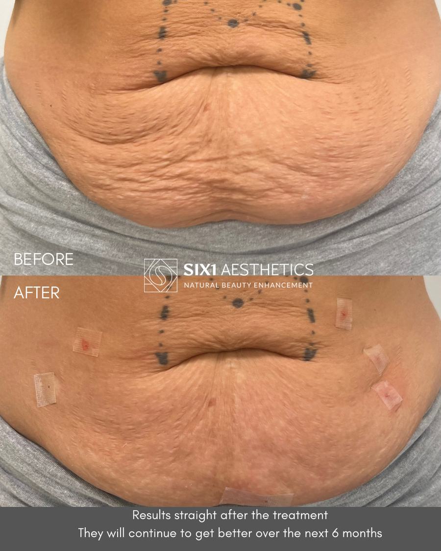 Endolaser before and after photos of a tummy showing firmer, smoother skin after one Endolaser treatment at SIX1 Aesthetics in Bracknell, Berkshire